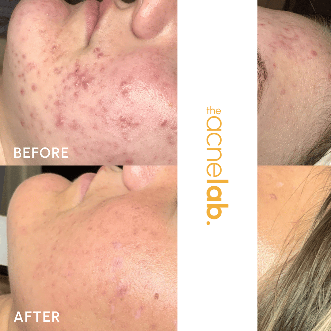 Before and after of teen girl who had cystic acne and got rid of her acne with acne skincare and support.