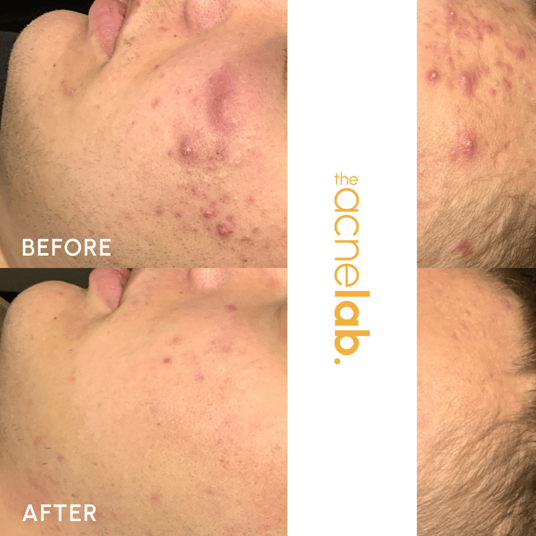 Before and after of a teen who had cystic acne and got clear skin with The Acne Lab.