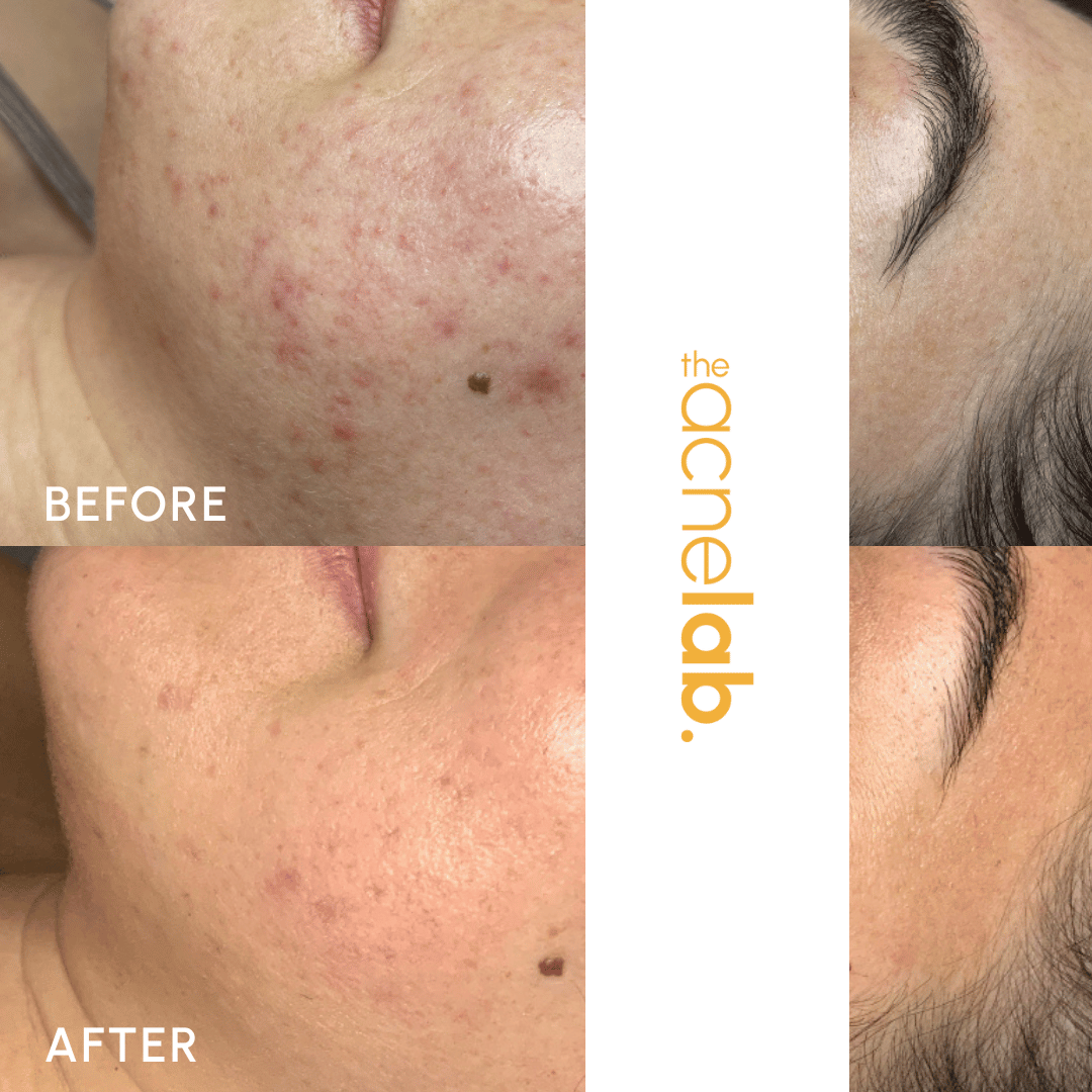 Honest review showing before and after of client who cleared up their acne with The Acne Lab.