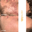 before and after of cystic acne treatment