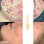 adult woman before and after of cystic acne treatment