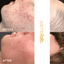 teen boy before and after of acne treatment in lafayette, co