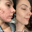 Honest review of The Acne Lab with before and after of women who got rid of her stubborn cystic acne.