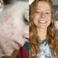 Before and after of woman with acne who cleared up her cystic acne with The Acne Lab skincare and support.
