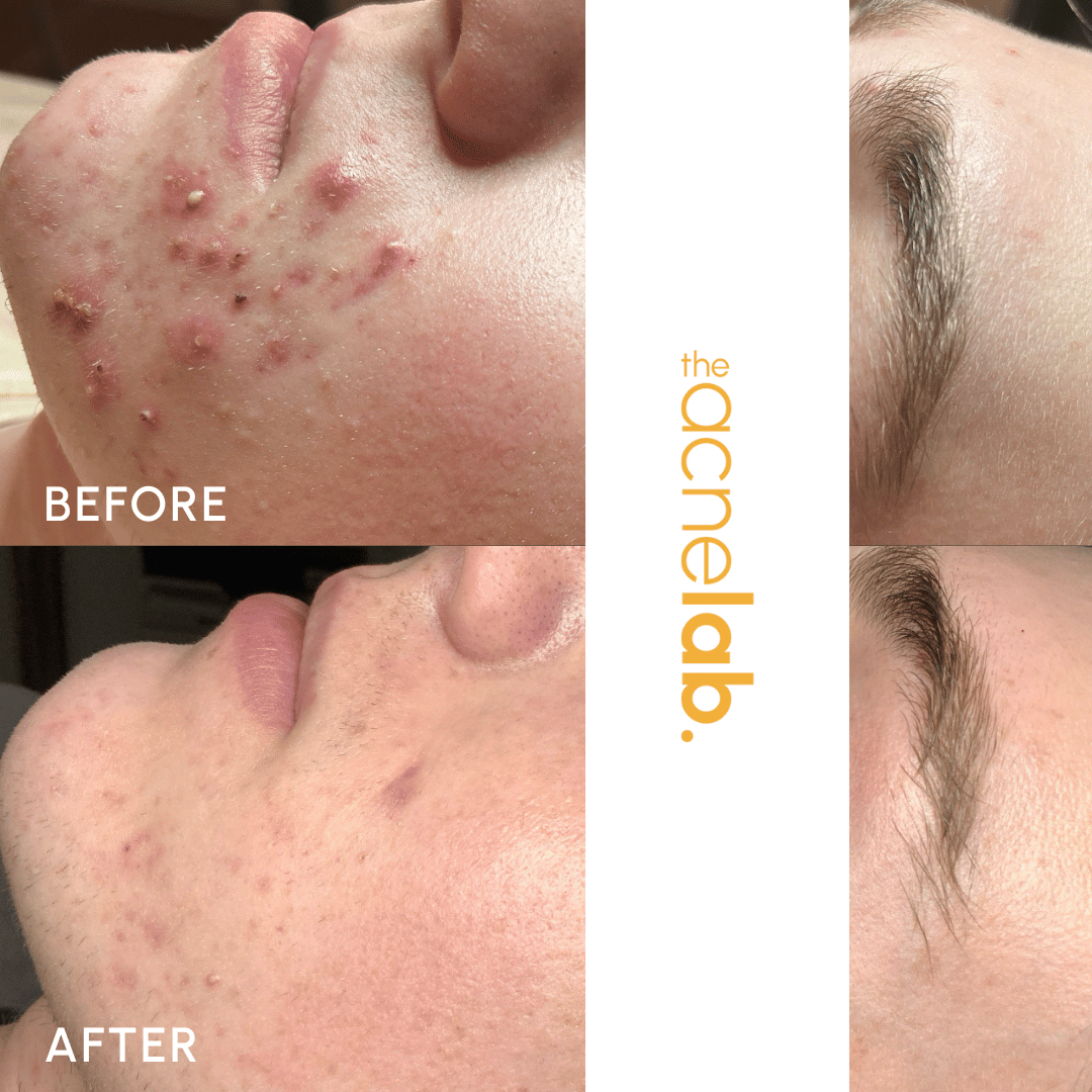 teen's honest review of cystic acne treatment that worked