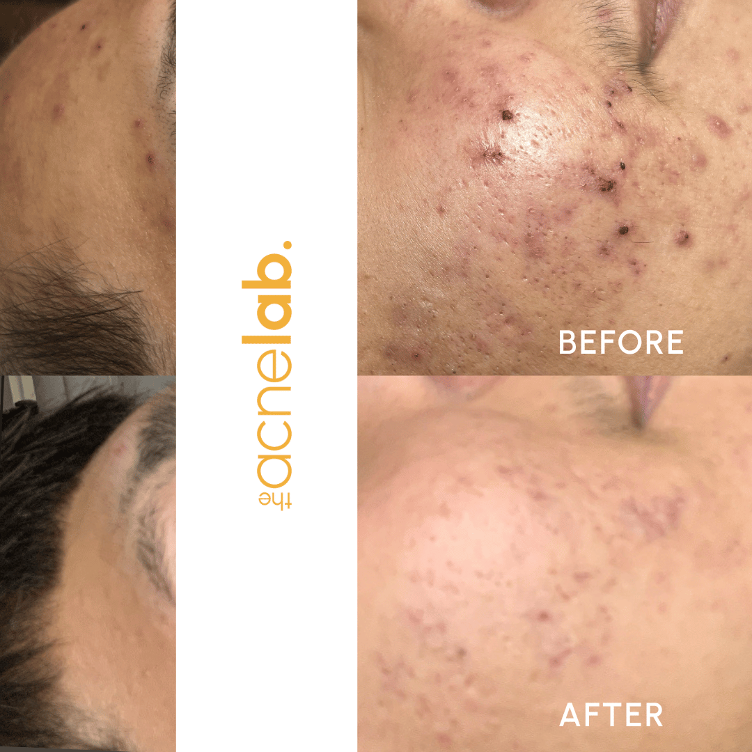 before and after of teen acne in Lafayette, CO