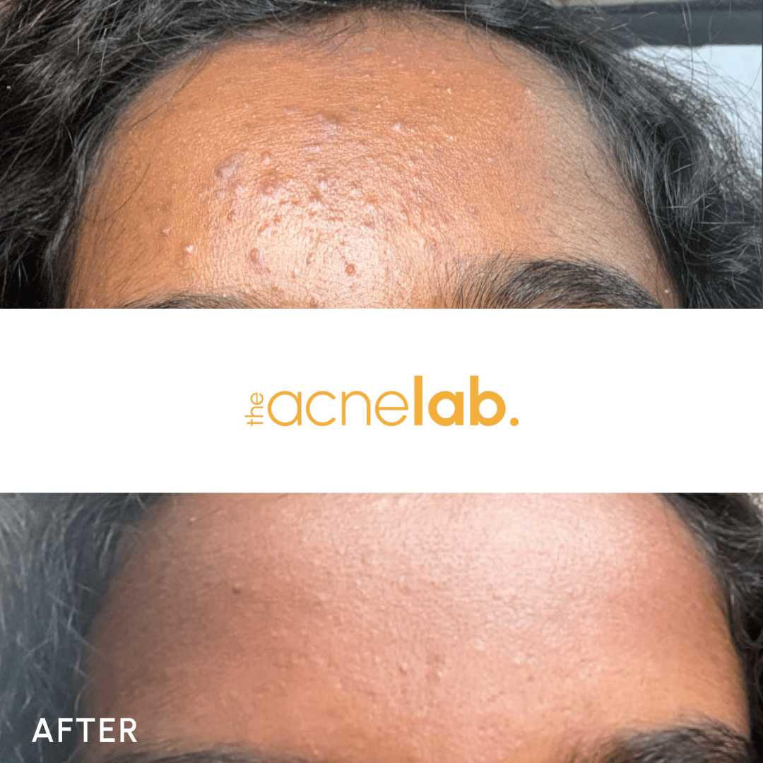 best treatment for acne and bumps on forehead