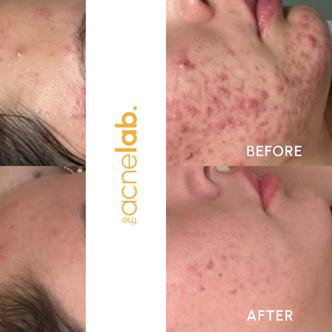 before and after of teen cystic acne in Lafayette, CO