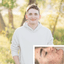 teen boy cleared up his cystic acne with the best acne treatment in Lafayette, CO