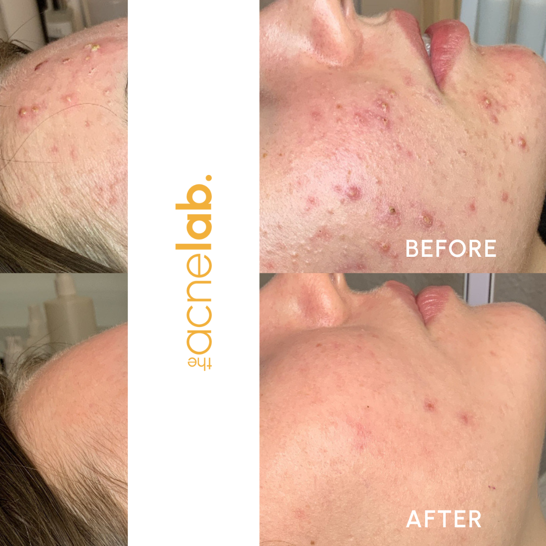 Before and after photos of a teen girl with red pimples and then after acne support and skincare